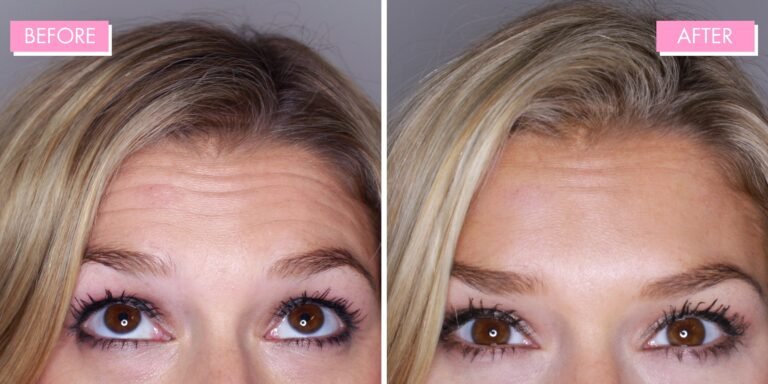 What to Know About Forehead Botox Before and After - The Source Full